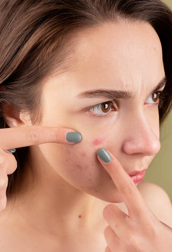 Woman with breakouts