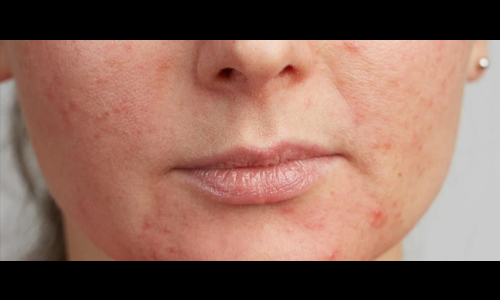 Retinol purge